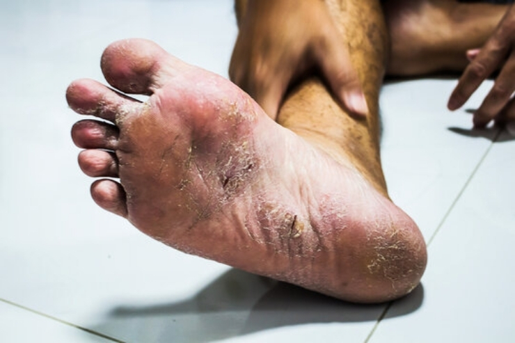 Fungal & Infectious Diseases